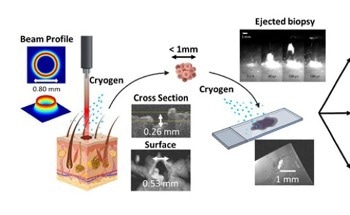 New Method Based on Laser Ablation to Make Biopsies Faster